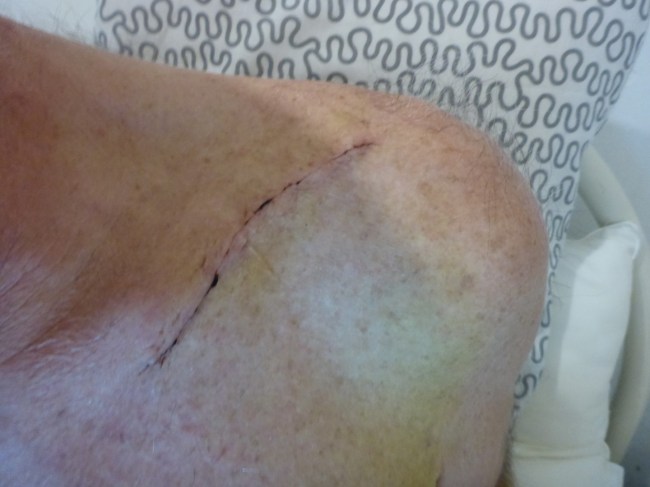 How it looks from the outside, two weeks after the operation. It's healed up nicely.