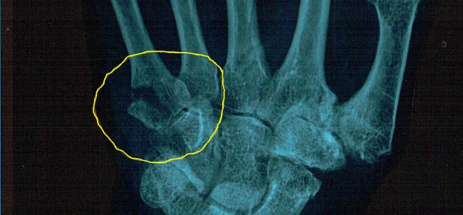 The piece of bone is a bit of a pain but will heal eventually.